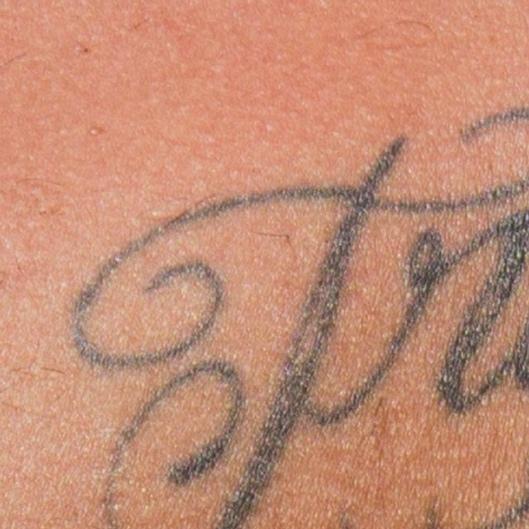 Post-Op Scar / Scar Revision